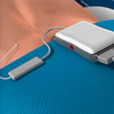 Global Dispositivos de terapia de neuroestimulación de onda sinusoidal de baja frecuencia Mercado