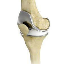 Global Total knee replacement Market
